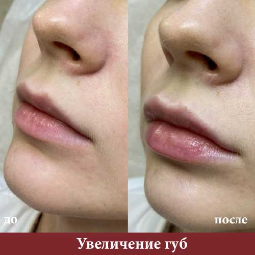 Филлеры для увеличения губ