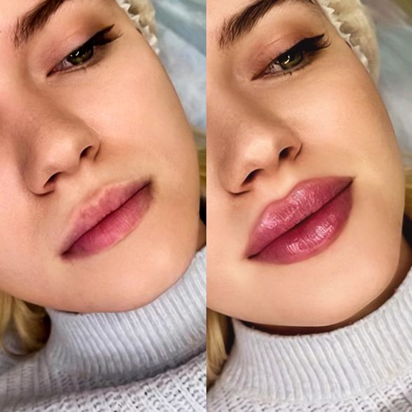 Процедура по увеличению губ