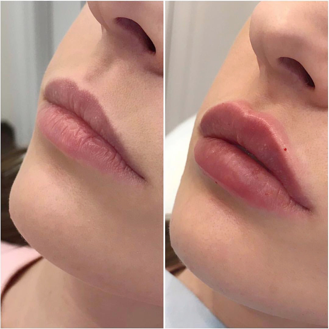 Увеличение объема губ