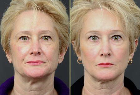 Радиесс Векторный Лифтинг Цена И Отзывы