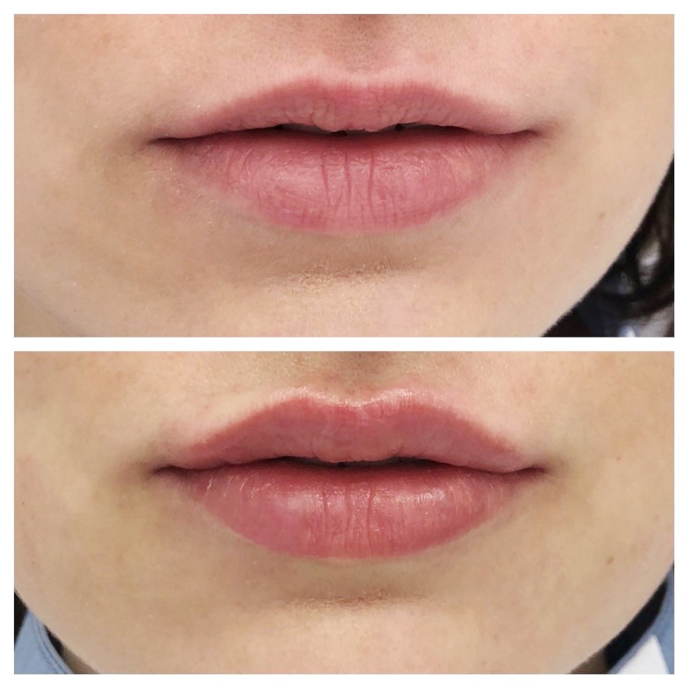 Увеличение губ Новосибирск